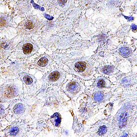 TGIF1 was detected in immersion fixed paraffin-embedded sections of human squamous cell carcinoma using Mouse Anti-Human TGIF1 Monoclonal Antibody (Catalog # MAB75551) at 25 µg/mL overnight at 4 °C. Tissue was stained using the Anti-Mouse HRP-DAB Cell & Tissue Staining Kit (brown; Catalog # CTS002) and counterstained with hematoxylin (blue). Specific staining was localized to nuclei. View our protocol for Chromogenic IHC Staining of Paraffin-embedded Tissue Sections.