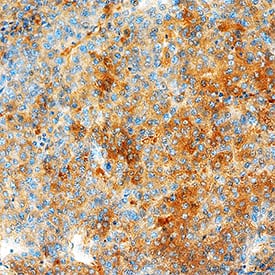 TIGAR/C12orf5 was detected in immersion fixed paraffin-embedded sections of human breast cancer tissue using Sheep Anti-Human TIGAR/C12orf5 Antigen Affinity-purified Polyclonal Antibody (Catalog # AF7629) at 1.7 µg/mL overnight at 4 °C. Tissue was stained using the Anti-Sheep HRP-DAB Cell & Tissue Staining Kit (brown; Catalog # CTS019) and counterstained with hematoxylin (blue). Specific staining was localized to cytoplasm and nuclei. View our protocol for Chromogenic IHC Staining of Paraffin-embedded Tissue Sections.