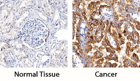 TIM-1/KIM-1/HAVCR was detected in immersion fixed paraffin-embedded sections of human kidney cancer tissue using Goat Anti-Human TIM-1/KIM-1/HAVCR Antigen Affinity-purified Polyclonal Antibody (Catalog # AF1750) at 1 µg/mL for 1 hour at room temperature followed by incubation with the Anti-Goat IgG VisUCyte™ HRP Polymer Antibody (Catalog # VC004). Tissue was stained using DAB (brown) and counterstained with hematoxylin (blue). Specific staining was localized to cancer cells. View our protocol for IHC Staining with VisUCyte HRP Polymer Detection Reagents.