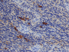 TIMP-1 was detected in immersion fixed paraffin-embedded sections of human astrocytoma using Mouse Anti-Human TIMP-1 Monoclonal Antibody (Catalog # MAB970) at 15 µg/mL overnight at 4 °C. Before incubation with the primary antibody tissue was subjected to heat-induced epitope retrieval using Antigen Retrieval Reagent-Basic (Catalog # CTS013). Tissue was stained using the Anti-Mouse HRP-DAB Cell & Tissue Staining Kit (brown; Catalog # CTS002) and counterstained with hematoxylin (blue). View our protocol for Chromogenic IHC Staining of Paraffin-embedded Tissue Sections.
