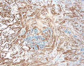 TIMP-4 was detected in immersion fixed paraffin-embedded sections of human breast cancer tissue using 25 µg/mL Mouse Anti-Human TIMP-4 Monoclonal Antibody (Catalog # MAB974) overnight at 4 °C. Tissue was stained with the Anti-Mouse HRP-DAB Cell & Tissue Staining Kit (brown; Catalog # CTS002) and counterstained with hematoxylin (blue). View our protocol for Chromogenic IHC Staining of Paraffin-embedded Tissue Sections.