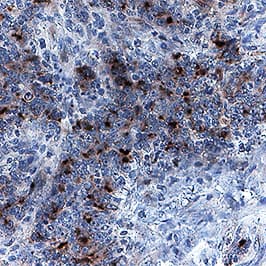 TIMP-1 was detected in immersion fixed paraffin-embedded sections of human colon cancer tissue using Goat Anti-Human TIMP-1 Antigen Affinity-purified Polyclonal Antibody (Catalog # AF970) at 1 µg/mL for 1 hour at room temperature followed by incubation with the Anti-Goat IgG VisUCyte™ HRP Polymer Antibody (Catalog # VC004). Before incubation with the primary antibody, tissue was subjected to heat-induced epitope retrieval using Antigen Retrieval Reagent-Basic (Catalog # CTS013). Tissue was stained using DAB (brown) and counterstained with hematoxylin (blue). Specific staining was localized to cytoplasm and extracellular space. View our protocol for IHC Staining with VisUCyte HRP Polymer Detection Reagents.
