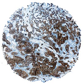 TIMP-2 was detected in immersion fixed paraffin-embedded sections of human pancreatic cancer tissue using Goat Anti-Human TIMP-2 Monoclonal Antibody (Catalog # MAB97112) at 3 µg/mL overnight at 4 °C. Tissue was stained using the Anti-Goat HRP-DAB Cell & Tissue Staining Kit (brown; Catalog # CTS008) and counterstained with hematoxylin (blue). Specific staining was localized to cytoplasm. View our protocol for Chromogenic IHC Staining of Paraffin-embedded Tissue Sections.
