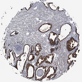 TL1A/TNFSF15 was detected in immersion fixed paraffin-embedded sections of human prostate cancer tissue using Rabbit Anti-Human TL1A/TNFSF15 Monoclonal Antibody (Catalog # MAB74421) at 0.3 µg/mL for 1 hour at room temperature followed by incubation with the Anti-Mouse IgG VisUCyte™ HRP Polymer Antibody (Catalog # VC001). Tissue was stained using DAB (brown) and counterstained with hematoxylin (blue). Specific staining was localized to cytoplasm of epithelial cells. View our protocol for IHC Staining with VisUCyte HRP Polymer Detection Reagents.