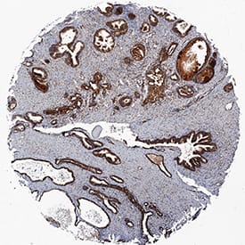 TL1A/TNFSF15 was detected in immersion fixed paraffin-embedded sections of human prostate cancer tissue using Rabbit Anti-Human TL1A/TNFSF15 Monoclonal Antibody (Catalog # MAB74422) at 0.3 µg/mL for 1 hour at room temperature followed by incubation with the Anti-Rabbit IgG VisUCyte™ HRP Polymer Antibody (VC003). Before incubation with the primary antibody, tissue was subjected to heat-induced epitope retrieval using Antigen Retrieval Reagent-Basic (CTS013). Tissue was stained using DAB (brown) and counterstained with hematoxylin (blue). Specific staining was localized to cytoplasm in epithelial cells. View our protocol for IHC Staining with VisUCyte HRP Polymer Detection Reagents.