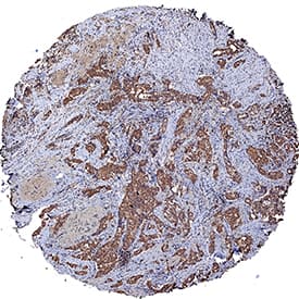 TM4SF1/L6 was detected in immersion fixed paraffin-embedded sections of human breast cancer tissue using Mouse Anti-Human TM4SF1/L6 Monoclonal Antibody (Catalog # MAB8164) at 5 µg/mL for 1 hour at room temperature followed by incubation with the Anti-Mouse IgG VisUCyte™ HRP Polymer Antibody (Catalog # VC001). Tissue was stained using DAB (brown) and counterstained with hematoxylin (blue). Specific staining was localized to cytoplasm in cancer cells. View our protocol for IHC Staining with VisUCyte HRP Polymer Detection Reagents.