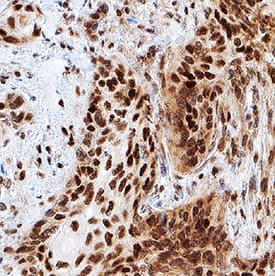 TOR was detected in immersion fixed paraffin-embedded sections of human squamous cell carcinoma using Rat Anti-Human TOR Monoclonal Antibody (Catalog # MAB15371) at 5 µg/mL overnight at 4 °C. Tissue was stained using the Anti-Rat HRP-DAB Cell & Tissue Staining Kit (brown; Catalog # CTS017) and counterstained with hematoxylin (blue). Specific staining was localized to nuclei. View our protocol for Chromogenic IHC Staining of Paraffin-embedded Tissue Sections.