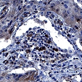 TPT1/TCTP was detected in immersion fixed paraffin-embedded sections of human squamous cell carcinoma of the lung using Mouse Anti-Human TPT1/TCTP Monoclonal Antibody (Catalog # MAB46481) at 0.1 µg/mL for 1 hour at room temperature followed by incubation with the Anti-Mouse IgG VisUCyte™ HRP Polymer Antibody (Catalog # VC001). Before incubation with the primary antibody, tissue was subjected to heat-induced epitope retrieval using Antigen Retrieval Reagent-Basic (Catalog # CTS013). Tissue was stained using DAB (brown) and counterstained with hematoxylin (blue). Specific staining was localized to cytoplasm. View our protocol for IHC Staining with VisUCyte HRP Polymer Detection Reagents.