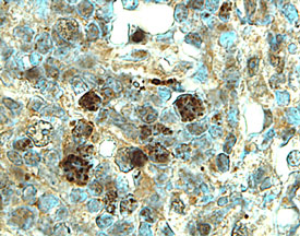 TRANCE/TNFSF11/RANK L was detected in immersion fixed paraffin-embedded sections of human lymph node using 5 µg/mL Mouse Anti-Human TRANCE/TNFSF11/RANK L Monoclonal Antibody (Catalog # MAB626) overnight at 4 °C. Tissue was stained with the Anti-Mouse HRP-DAB Cell & Tissue Staining Kit (brown; Catalog # CTS002) and counterstained with hematoxylin (blue). View our protocol for Chromogenic IHC Staining of Paraffin-embedded Tissue Sections.