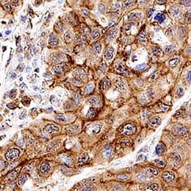 TROP-2 was detected in immersion fixed paraffin-embedded sections of human cervical cancer tissue using Goat Anti-Human TROP-2 Biotinylated Antigen Affinity-purified Polyclonal Antibody (Catalog # BAF650) at 3 µg/mL overnight at 4 °C. Before incubation with the primary antibody, tissue was subjected to heat-induced epitope retrieval using Antigen Retrieval Reagent-Basic (Catalog # CTS013). Tissue was stained using the Anti-Goat IgG VisUCyte™ HRP Polymer Antibody (brown; Catalog # VC004) and counterstained with hematoxylin (blue). Specific staining was localized to cell membrane in cancer cells. View our protocol for IHC Staining with VisUCyte HRP Polymer Detection Reagents.