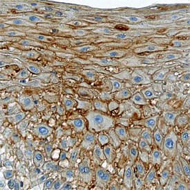 TTK was detected in immersion fixed paraffin-embedded sections of human squamous cell carcinoma using Sheep Anti-Human TTK Antigen Affinity-purified Polyclonal Antibody (Catalog # AF6028) at 15 µg/mL overnight at 4 °C. Tissue was stained using the Anti-Sheep HRP-DAB Cell & Tissue Staining Kit (brown; Catalog # CTS019) and counterstained with hematoxylin (blue). Specific staining was localized to plasma membranes of epithelial cells. View our protocol for Chromogenic IHC Staining of Paraffin-embedded Tissue Sections.
