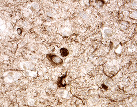 Tau was detected in immersion fixed paraffin-embedded sections of human Alzheimer's disease brain (cortex) using 5 &micro;g/mL Goat Anti-Tau Antigen Affinity-purified Polyclonal Antibody (Catalog # AF3494) overnight at 4 &deg;C. Tissue was stained with the Anti-Goat HRP-DAB Cell & Tissue Staining Kit (brown; Catalog # CTS008) and counterstained with hematoxylin (blue). View our protocol for Chromogenic IHC Staining of Paraffin-embedded Tissue Sections.