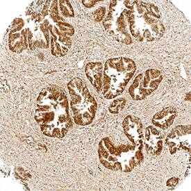 Tensin 4/CTEN was detected in immersion fixed paraffin-embedded sections of human prostate using Mouse Anti-Human Tensin 4/ CTEN Monoclonal Antibody (Catalog # MAB6925) at 25 µg/mL overnight at 4 °C. Tissue was stained using the Anti-Mouse HRP-DAB Cell & Tissue Staining Kit (brown; Catalog # CTS002) and counterstained with hematoxylin (blue). Specific staining was localized to cytoplasm in epithelial cells. View our protocol for Chromogenic IHC Staining of Paraffin-embedded Tissue Sections.