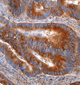 Thrombospondin-1 was detected in immersion fixed paraffin-embedded sections of human colon using Goat Anti-Human Thrombospondin-1 Antigen Affinity-purified Polyclonal Antibody (Catalog # AF3074) at 1.7 µg/mL overnight at 4 °C. Tissue was stained using the Anti-Goat HRP-DAB Cell & Tissue Staining Kit (brown; Catalog # CTS008) and counterstained with hematoxylin (blue). Specific staining was localized to the cytoplasm of epithelial cells. View our protocol for Chromogenic IHC Staining of Paraffin-embedded Tissue Sections.