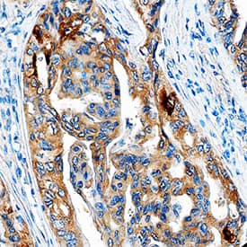Thyroglobulin was detected in immersion fixed paraffin-embedded sections of human thyroid cancer tissue using Mouse Anti-Human Thyroglobulin Monoclonal Antibody (Catalog # MAB8306) at 15 µg/mL overnight at 4 °C. Tissue was stained using the Anti-Rabbit HRP-DAB Cell & Tissue Staining Kit (brown; Catalog # CTS005) and counterstained with hematoxylin (blue). Specific staining was localized to epithelial cells. View our protocol for Chromogenic IHC Staining of Paraffin-embedded Tissue Sections.