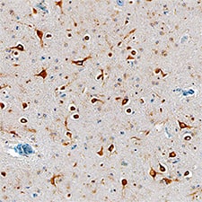 Tmp21/p23 was detected in immersion fixed paraffin-embedded sections of human Alzheimer's brain using Sheep Anti-Human/Mouse Tmp21/p23 Antigen Affinity-purified Polyclonal Antibody (Catalog # AF7630) at 1 µg/mL overnight at 4 °C. Tissue was stained using the Anti-Sheep HRP-DAB Cell & Tissue Staining Kit (brown; Catalog # CTS019) and counterstained with hematoxylin (blue). Specific staining was localized to cytoplasm in glial cells. View our protocol for Chromogenic IHC Staining of Paraffin-embedded Tissue Sections.