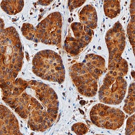 TopBP1 was detected in immersion fixed paraffin-embedded sections of human breast using Sheep Anti-Human TopBP1 Antigen Affinity-purified Polyclonal Antibody (Catalog # AF7120) at 3 µg/mL overnight at 4 °C. Before incubation with the primary antibody, tissue was subjected to heat-induced epitope retrieval using Antigen Retrieval Reagent-Basic (Catalog # CTS013). Tissue was stained using the Anti-Sheep HRP-DAB Cell & Tissue Staining Kit (brown; Catalog # CTS019) and counterstained with hematoxylin (blue). Specific staining was localized to epithelial cells. View our protocol for Chromogenic IHC Staining of Paraffin-embedded Tissue Sections.