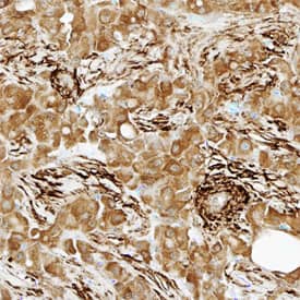 Transgelin/TAGLN was detected in immersion fixed paraffin-embedded sections of human liver cancer tissue using Sheep Anti-Human/Mouse/Rat Transgelin/TAGLN Antigen Affinity-purified Polyclonal Antibody (Catalog # AF7886) at 1.7 µg/mL overnight at 4 °C. Tissue was stained using the Anti-Sheep HRP-DAB Cell & Tissue Staining Kit (brown; Catalog # CTS019) and counterstained with hematoxylin (blue). Specific staining was localized to connective tissue. View our protocol for Chromogenic IHC Staining of Paraffin-embedded Tissue Sections.