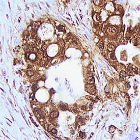 Trypsin was detected in immersion fixed paraffin-embedded sections of human pancreatic cancer tissue using Sheep Anti-Human Trypsin Pan Specific (PRSS1/2/3) Antigen Affinity-purified Polyclonal Antibody (Catalog # AF3586) at 5 µg/mL overnight at 4 °C. Tissue was stained using the Anti-Sheep HRP-DAB Cell & Tissue Staining Kit (brown; Catalog # CTS019) and counterstained with hematoxylin (blue). Specific staining was localized to cytoplasm of cancer cells. View our protocol for Chromogenic IHC Staining of Paraffin-embedded Tissue Sections.