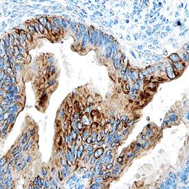 ULBP-4/RAET1E was detected in immersion fixed paraffin-embedded sections of human ovarian cancer tissue using Mouse Anti-Human ULBP-4/ RAET1E Monoclonal Antibody (Catalog # MAB6285) at 15 µg/mL overnight at 4 °C. Tissue was stained using the Anti-Mouse HRP-DAB Cell & Tissue Staining Kit (brown; CTS002) and counter-stained with hematoxylin (blue). Specific staining was localized to plasma membranes of epithelial cells. View our protocol for Chromogenic IHC Staining of Paraffin-embedded Tissue Sections.