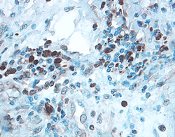 ULBP-2/5/6 was detected in immersion fixed paraffin-embedded sections of human colon cancer tissue using 10 µg/mL Goat Anti-Human ULBP-2/5/6 Antigen Affinity-purified Polyclonal Antibody (Catalog # AF1298) overnight at 4 °C. Before incubation with the primary antibody tissue was subjected to heat-induced epitope retrieval using Antigen Retrieval Reagent-Basic (Catalog # CTS013). Tissue was stained with the Anti-Goat HRP-DAB Cell & Tissue Staining Kit (brown; Catalog # CTS008) and counterstained with hematoxylin (blue). View our protocol for Chromogenic IHC Staining of Paraffin-embedded Tissue Sections.