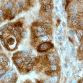 Uteroglobin/SCGB1A1 was detected in immersion fixed paraffin-embedded sections of human endometrial cancer tissue using Human Uteroglobin/SCGB1A1 Antigen Affinity-purified Polyclonal Antibody (Catalog # AF4218) at 3 µg/mL overnight at 4 °C. Before incubation with the primary antibody, tissue was subjected to heat-induced epitope retrieval using Antigen Retrieval Reagent-Basic (CTS013). Tissue was stained using the Anti-Sheep HRP-DAB Cell & Tissue Staining Kit (brown; CTS019) and counterstained with hematoxylin (blue). Specific staining was localized to cytoplasm of epithelial cells. View our protocol for Chromogenic IHC Staining of Paraffin-embedded Tissue Sections.