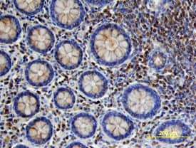 VEGF-C was detected in immersion fixed paraffin-embedded sections of human colon cancer tissue using Goat Anti-Human VEGF-C Antigen Affinity-purified Polyclonal Antibody (Catalog # AF752) at 10 µg/mL overnight at 4 °C. Tissue was stained using the Anti-Goat HRP-DAB Cell & Tissue Staining Kit (brown; CTS008) and counterstained with hematoxylin (blue). Specific labeling was localized to stromal cells surrounding crypts in the colon mucosa (cross section across crypts). View our protocol for Chromogenic IHC Staining of Paraffin-embedded Tissue Sections.