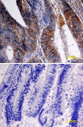 VEGF-C was detected in immersion fixed paraffin-embedded sections of human colon cancer tissue using Goat Anti-Human VEGF-C Antigen Affinity-purified Polyclonal Antibody (Catalog # AF752) at 15 µg/mL overnight at 4 °C. Tissue was stained using the Anti-Goat HRP-DAB Cell & Tissue Staining Kit (brown; CTS008) and counterstained with hematoxylin (blue). Specific labeling was localized to epithelial cells in crypts of the colon mucusa (longitudinal section of crypts). Lower panel shows a lack of labeling if primary antibodies are omitted and tissue is stained only with secondary antibody followed by incubation with detection reagents. View our protocol for Chromogenic IHC Staining of Paraffin-embedded Tissue Sections.