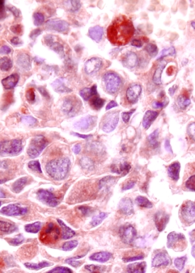 VEGF165was detected in immersion fixed frozen sections of human breast cancer tissue using 5 &micro;g/mL Human VEGF165Polyclonal Antibody (Catalog # AB‑293‑NA) overnight at 4 &deg;C. Tissue was stained (red) and counterstained with hematoxylin (blue). View our protocol for Chromogenic IHC Staining of Frozen Tissue Sections.