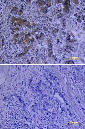 VEGF was detected in immersion fixed paraffin-embedded sections of human breast cancer tissue using Human VEGF 165 Polyclonal Antibody (Catalog # AB-293-NA) at 15 µg/mL overnight at 4 °C. Tissue was stained using the Anti-Goat HRP-DAB Cell & Tissue Staining Kit (brown; Catalog # CTS008) and counterstained with hematoxylin (blue). Lower panel shows a lack of labeling if primary antibodies are omitted and tissue is stained only with secondary antibody followed by incubation with detection reagents. View our protocol for Chromogenic IHC Staining of Paraffin-embedded Tissue Sections.