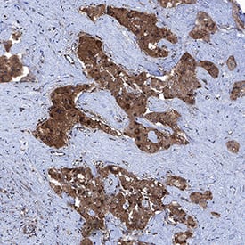 VEGF was detected in immersion fixed paraffin-embedded sections of human liver cancer tissue using Goat Anti-Human VEGF165 Antigen Affinity-purified Polyclonal Antibody (Catalog # AF-293-NA) at 3 &micro;g/mL for 1 hour at room temperature followed by incubation with the Anti-Goat IgG VisUCyte&trade; HRP Polymer Antibody (VC004). Before incubation with the primary antibody, tissue was subjected to heat-induced epitope retrieval using Antigen Retrieval Reagent-Basic (CTS013). Tissue was stained using DAB (brown) and counterstained with hematoxylin (blue). Specific staining was localized to cytoplasm in cancer cells. View our protocol for IHC Staining with VisUCyte HRP Polymer Detection Reagents.