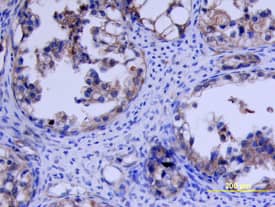 VEGFR1/Flt-1 was detected in immersion fixed paraffin-embedded sections of human ovarian cancer tissue using Human VEGFR1/Flt-1 Antigen Affinity-purified Polyclonal Antibody (Catalog # AF321) at 3 µg/mL overnight at 4 °C. Tissue was stained using the Anti-Goat HRP-DAB Cell & Tissue Staining Kit (brown; CTS008) and counterstained with hematoxylin (blue). View our protocol for Chromogenic IHC Staining of Paraffin-embedded Tissue Sections.
