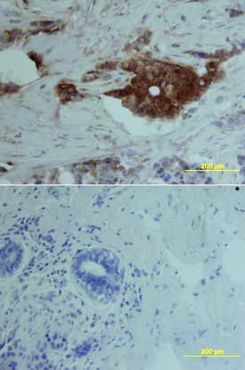 VEGFR1/Flt-1 was detected in immersion fixed paraffin-embedded sections of human breast array using Human VEGFR1/Flt-1 Biotinylated Antigen Affinity-purified Polyclonal Antibody (Catalog # BAF321) at 15 µg/mL overnight at 4 °C. Tissue was stained using the Anti-Goat HRP-DAB Cell & Tissue Staining Kit (brown; Catalog # CTS008) and counterstained with hematoxylin (blue). Lower panel shows a lack of labeling if primary antibodies are omitted and tissue is stained only with secondary antibody followed by incubation with detection reagents. View our protocol for Chromogenic IHC Staining of Paraffin-embedded Tissue Sections.