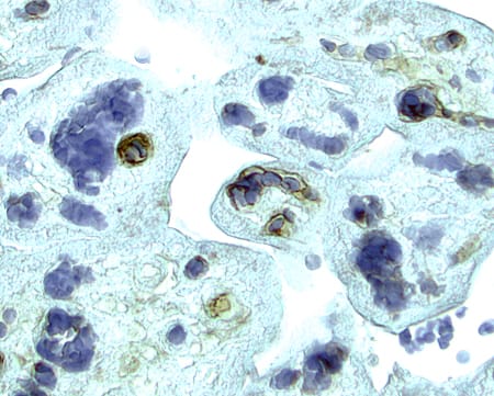 VEGFR2/KDR/Flk-1 was detected in immersion fixed paraffin-embedded sections of human placenta using 15 µg/mL Goat Anti-Human VEGFR2/KDR/Flk-1 Antigen Affinity-purified Polyclonal Antibody (Catalog # AF357) overnight at 4 °C. Tissue was stained with the Anti-Goat HRP-AEC Cell & Tissue Staining Kit (red; Catalog # CTS009) and counterstained with hematoxylin (blue). View our protocol for Chromogenic IHC Staining of Paraffin-embedded Tissue Sections.