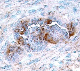 VEGFR3/Flt-4 was detected in immersion fixed paraffin-embedded sections of human cervical squamous metaplasia using Human VEGFR3/Flt-4 Antigen Affinity-purified Polyclonal Antibody (Catalog # AF349) at 15 µg/mL overnight at 4 °C. Tissue was stained using the Anti-Goat HRP-DAB Cell & Tissue Staining Kit (brown; Catalog # CTS008) and counterstained with hematoxylin (blue). View our protocol for Chromogenic IHC Staining of Paraffin-embedded Tissue Sections.