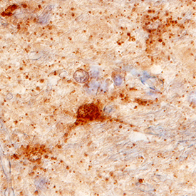 VGLUT1/SLC17A7 was detected in immersion fixed paraffin-embedded sections of human brain (cortex) using Mouse Anti-Human VGLUT1/SLC17A7 Monoclonal Antibody (Catalog # MAB9054) at 15 µg/mL overnight at 4 °C. Tissue was stained using the Anti-Mouse HRP-DAB Cell & Tissue Staining Kit (brown; Catalog # CTS002) and counterstained with hematoxylin (blue). Specific staining was localized to synaptic vesicles. View our protocol for Chromogenic IHC Staining of Paraffin-embedded Tissue Sections.