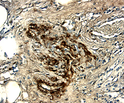 WISP‑1/CCN4 was detected in immersion fixed paraffin-embedded sections of human breast cancer tissue using 15 &micro;g/mL Goat Anti-Human WISP‑1/CCN4 Antigen Affinity-purified Polyclonal Antibody (Catalog # AF1627) overnight at 4 &deg;C. Tissue was stained with the Anti-Goat HRP-DAB Cell & Tissue Staining Kit (brown; Catalog # CTS008) and counterstained with hematoxylin (blue). View our protocol for Chromogenic IHC Staining of Paraffin-embedded Tissue Sections.