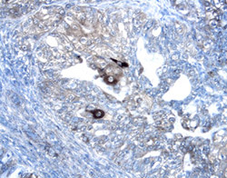 Wnt-7a/b was detected in immersion fixed paraffin-embedded sections of human endometrial cancer tissue using 15 µg/mL Goat Anti-Human Wnt-7a/b Antigen Affinity-purified Polyclonal Antibody (Catalog # AF3008) overnight at 4 °C. Tissue was stained with the Anti-Goat HRP-DAB Cell & Tissue Staining Kit (brown; Catalog # CTS008) and counterstained with hematoxylin (blue). View our protocol for Chromogenic IHC Staining of Paraffin-embedded Tissue Sections.