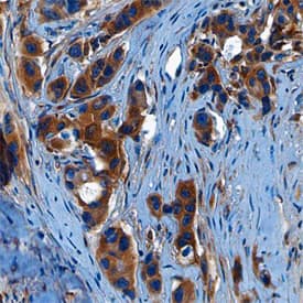 Wnt-10b was detected in immersion fixed paraffin-embedded sections of human breast cancer tissue using Mouse Anti-Human Wnt-10b Monoclonal Antibody (Catalog # MAB71961) at 15 µg/mL overnight at 4 °C. Before incubation with the primary antibody, tissue was subjected to heat-induced epitope retrieval using Antigen Retrieval Reagent-Basic (Catalog # CTS013). Tissue was stained using the Anti-Mouse HRP-DAB Cell & Tissue Staining Kit (brown; Catalog # CTS002) and counter-stained with hematoxylin (blue). Specific staining was localized to cytoplasm of cancer cells. View our protocol for Chromogenic IHC Staining of Paraffin-embedded Tissue Sections.