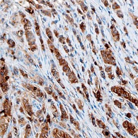 ZAG was detected in immersion fixed paraffin-embedded sections of human breast cancer tissue using Goat Anti-Human ZAG Antigen Affinity-purified Polyclonal Antibody (Catalog # AF4764) at 10 µg/mL overnight at 4 °C. Before incubation with the primary antibody, tissue was subjected to heat-induced epitope retrieval using Antigen Retrieval Reagent-Basic (Catalog # CTS013). Tissue was stained using the Anti-Goat HRP-DAB Cell & Tissue Staining Kit (brown; Catalog # CTS008) and counterstained with hematoxylin (blue). Specific staining was localized to epithelial cells. View our protocol for Chromogenic IHC Staining of Paraffin-embedded Tissue Sections.
