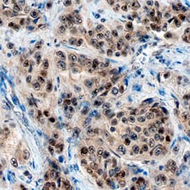 ZEB2/SIP1 was detected in immersion fixed paraffin-embedded sections of human liver using Mouse Anti-Human ZEB2/SIP1 Monoclonal Antibody (Catalog # MAB73782) at 15 µg/mL overnight at 4 °C. Tissue was stained using the Anti-Mouse HRP-DAB Cell & Tissue Staining Kit (brown; Catalog # CTS002) and counterstained with hematoxylin (blue). Specific staining was localized to nuclei in hepatocytes. View our protocol for Chromogenic IHC Staining of Paraffin-embedded Tissue Sections.
