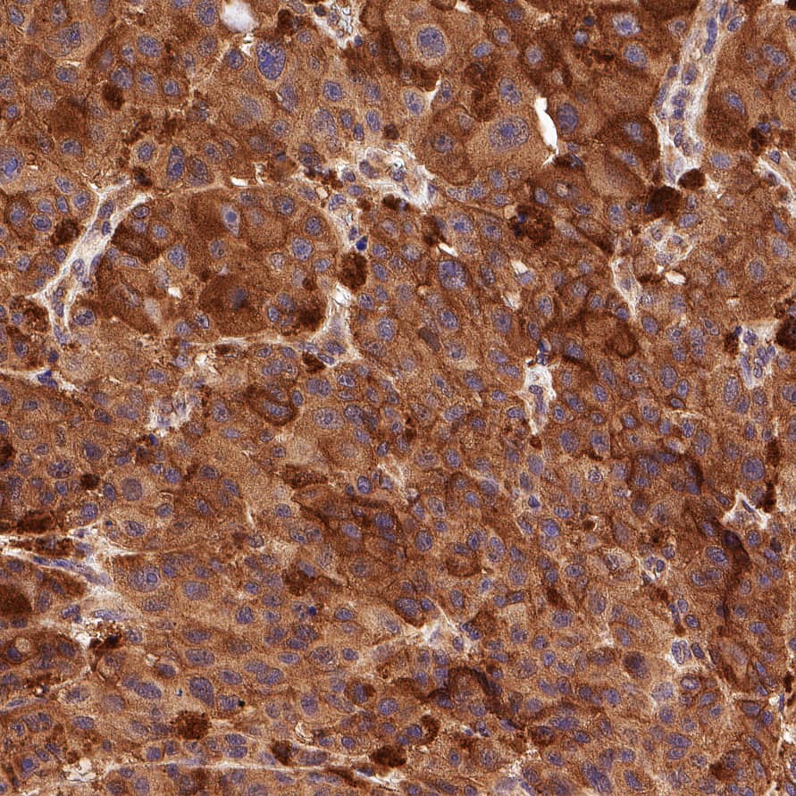 CD117/c-kit was detected in immersion fixed paraffin-embedded sections of human melanoma using Goat Anti-Human/Mouse CD117/c-kit Antigen Affinity-purified Polyclonal Antibody (Catalog # AF1356) at 0.5 µg/ml overnight at 4 °C. Before incubation with the primary antibody, tissue was subjected to heat-induced epitope retrieval using VisUCyte Antigen Retrieval Reagent-Basic (Catalog # VCTS021). Tissue was stained using the HRP-conjugated Anti-Goat IgG Secondary Antibody (Catalog # HAF109) and counterstained with hematoxylin (blue). Specific staining was localized to the cell membrane and cytoplasm. View our protocol for Chromogenic IHC Staining of Paraffin-embedded Tissue Sections.