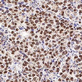 Nanog was detected in immersion fixed paraffin-embedded sections of human testicular cancer using Goat Anti-Human Nanog Antigen Affinity-purified Polyclonal Antibody (Catalog # AF1997) at 1 &micro;g/mL for 1 hour at room temperature followed by incubation with the Anti-Goat IgG VisUCyte&trade; HRP Polymer Antibody (VC004). Before incubation with the primary antibody, tissue was subjected to heat-induced epitope retrieval using Antigen Retrieval Reagent-Basic (CTS013). Tissue was stained using DAB (brown) and counterstained with hematoxylin (blue).  Specific staining was localized to cell nuclei. Staining was performed using our protocol for IHC Staining with VisUCyte HRP Polymer Detection Reagents.