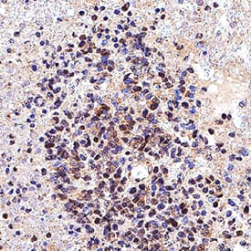 SOX10 was detected in immersion fixed paraffin-embedded sections of human melanoma tissue using Goat Anti-Human SOX10 Antigen Affinity-purified Polyclonal Antibody (Catalog # AF2864) at 15 &micro;g/mL for 1 hour at room temperature followed by incubation with the Anti-Goat IgG VisUCyte&trade; HRP Polymer Antibody (VC004). Before incubation with the primary antibody, tissue was subjected to heat-induced epitope retrieval using Antigen Retrieval Reagent-Basic (CTS013). Tissue was stained using DAB (brown) and counterstained with hematoxylin (blue). Specific staining was localized to cell nuclei. Staining was performed using our protocol for IHC Staining with VisUCyte HRP Polymer Detection Reagents.