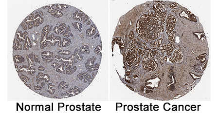 BMPR‑IA/ALK‑3 was detected in immersion fixed paraffin-embedded sections of normal human prostate tissue (negative) and human prostate cancer tissue (positive) using Goat Anti-Human BMPR‑IA/ALK‑3 Antigen Affinity-purified Polyclonal Antibody (Catalog # AF346) at 1 &micro;g/mL for 1 hour at room temperature followed by incubation with the Anti-Sheep IgG VisUCyte&trade; HRP Polymer Antibody (VC006). Tissue was stained using DAB (brown) and counterstained with hematoxylin (blue). Specific staining was localized to epithelial cells and stroma. Staining was performed using our IHC Staining with VisUCyte HRP Polymer Detection Reagents.