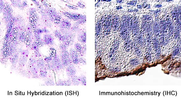 Formalin-fixed paraffin-embedded tissue sections of human colon cancer were probed for NT5E mRNA (ACD RNAScope Probe, catalog #437931; Fast Red chromogen, ACD catalog # 322750). Adjacent tissue section was processed for immunohistochemistry using sheep anti-human NT5E polyclonal antibody (R&D Systems catalog # AF5795) at 1ug/mL with overnight incubation at 4 degrees Celsius followed by incubation with anti-sheep IgG VisUCyte HRP Polymer Antibody (Catalog # VC006) and DAB chromogen (yellow-brown). Tissue was counterstained with hematoxylin (blue). Specific staining was localized to glandular cells. 