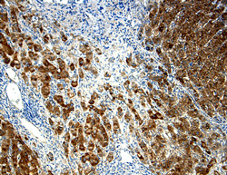  alpha ‑Fetoprotein/AFP was detected in immersion fixed paraffin-embedded sections of human liver cancer using 15 µg/mL Chicken anti-Human/ Rat  alpha ‑Fetoprotein/AFP Antigen Affinity-purified Polyclonal Antibody (Catalog # AF1369) overnight at 4 °C. Tissue was stained (brown) and counterstained with hematoxylin (blue). View our protocol for Chromogenic IHC Staining of Paraffin-embedded Tissue Sections.