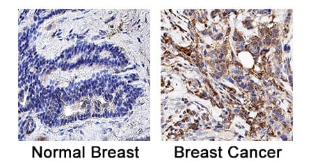 Cathepsin X/Z/P was detected in immersion fixed paraffin-embedded sections of human breast cancer tissue using Goat Anti-Human Cathepsin X/Z/P Biotinylated Antigen Affinity-purified Polyclonal Antibody (Catalog # BAF934) at 3 µg/mL for 1 hour at room temperature followed by incubation with the Anti-Goat IgG VisUCyte™ HRP Polymer Antibody (VC004). Before incubation with the primary antibody, tissue was subjected to heat-induced epitope retrieval using Antigen Retrieval Reagent-Basic (CTS013). Tissue was stained using DAB (brown) and counterstained with hematoxylin (blue).  Specific staining was localized to cytoplasm. Staining was performed using our protocol for IHC Staining with VisUCyte HRP Polymer Detection Reagents.