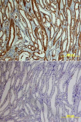  beta -Catenin was detected in immersion fixed paraffin-embedded sections of human kidney cancer tissue using Goat Anti-Human/Mouse/Rat  beta -Catenin Antigen Affinity-purified Polyclonal Antibody (Catalog # AF1329) at 15 µg/mL overnight at 4 °C. Tissue was stained using the Anti-Goat HRP-DAB Cell & Tissue Staining Kit (brown; Catalog # CTS008) and counterstained with hematoxylin (blue). Lower panel shows a lack of labeling if primary antibodies are omitted and tissue is stained only with secondary antibody followed by incubation with detection reagents. View our protocol for Chromogenic IHC Staining of Paraffin-embedded Tissue Sections.