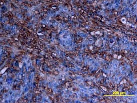 cIAP-2/HIAP-1 was detected in immersion fixed paraffin-embedded sections of human colon cancer tissue using Mouse Anti-Human/Mouse cIAP-2/ HIAP-1 Monoclonal Antibody (Catalog # MAB817) at 25 µg/mL overnight at 4 °C. Tissue was stained using the Anti-Mouse HRP-DAB Cell & Tissue Staining Kit (brown; Catalog # CTS002) and counter-stained with hematoxylin (blue). View our protocol for Chromogenic IHC Staining of Paraffin-embedded Tissue Sections. This application has not been tested in mouse samples.